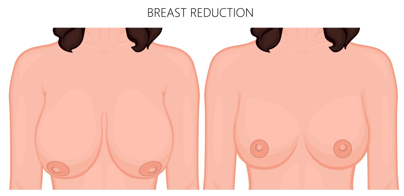 Image result for breast reduction images